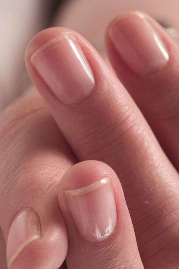 jak zregenerować paznokcie onychiloza