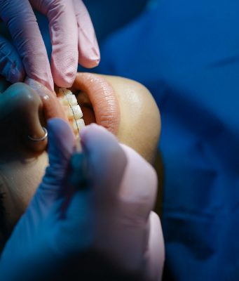 Jak dbać o aparat ortodontyczny w domu